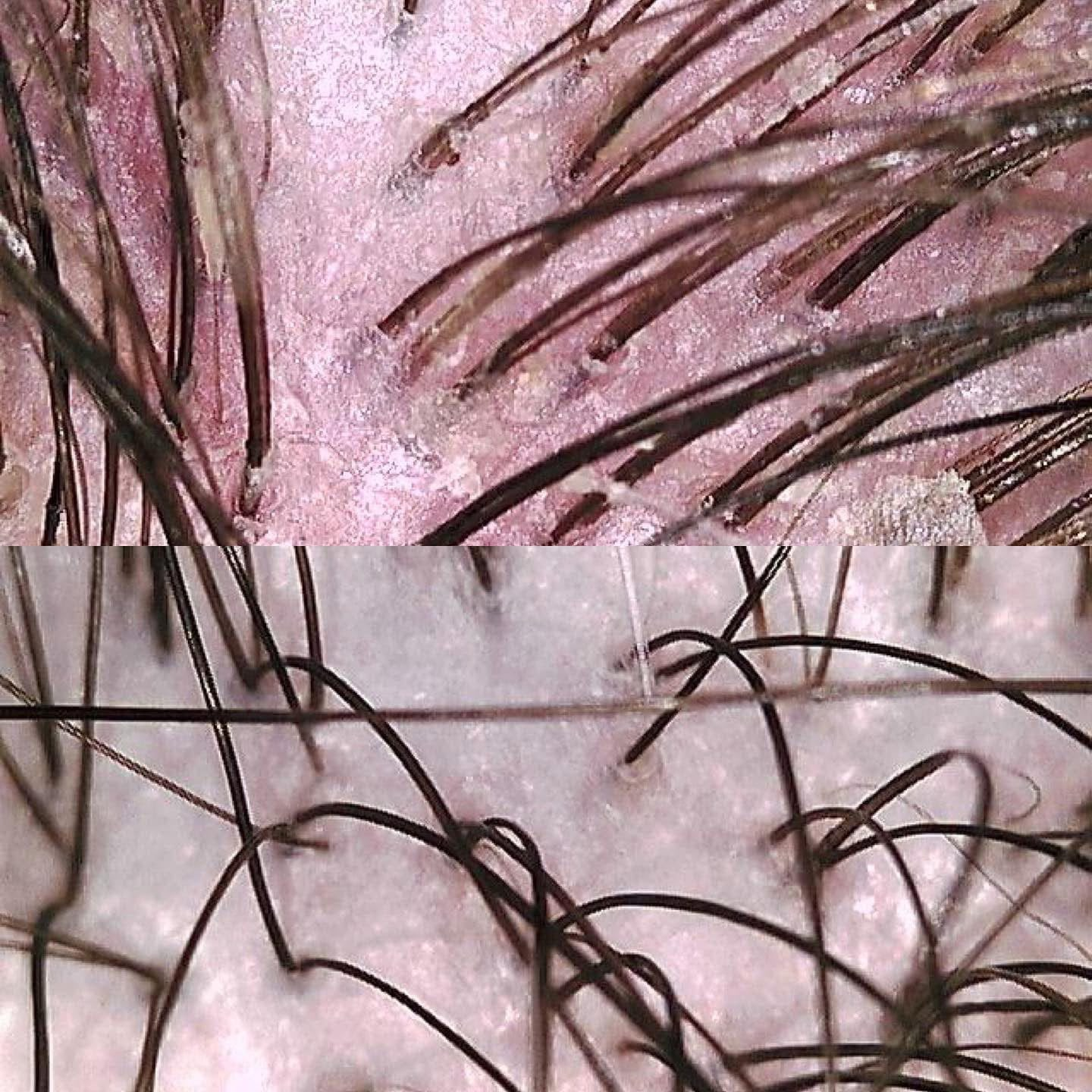 Scalp Detox Before & After