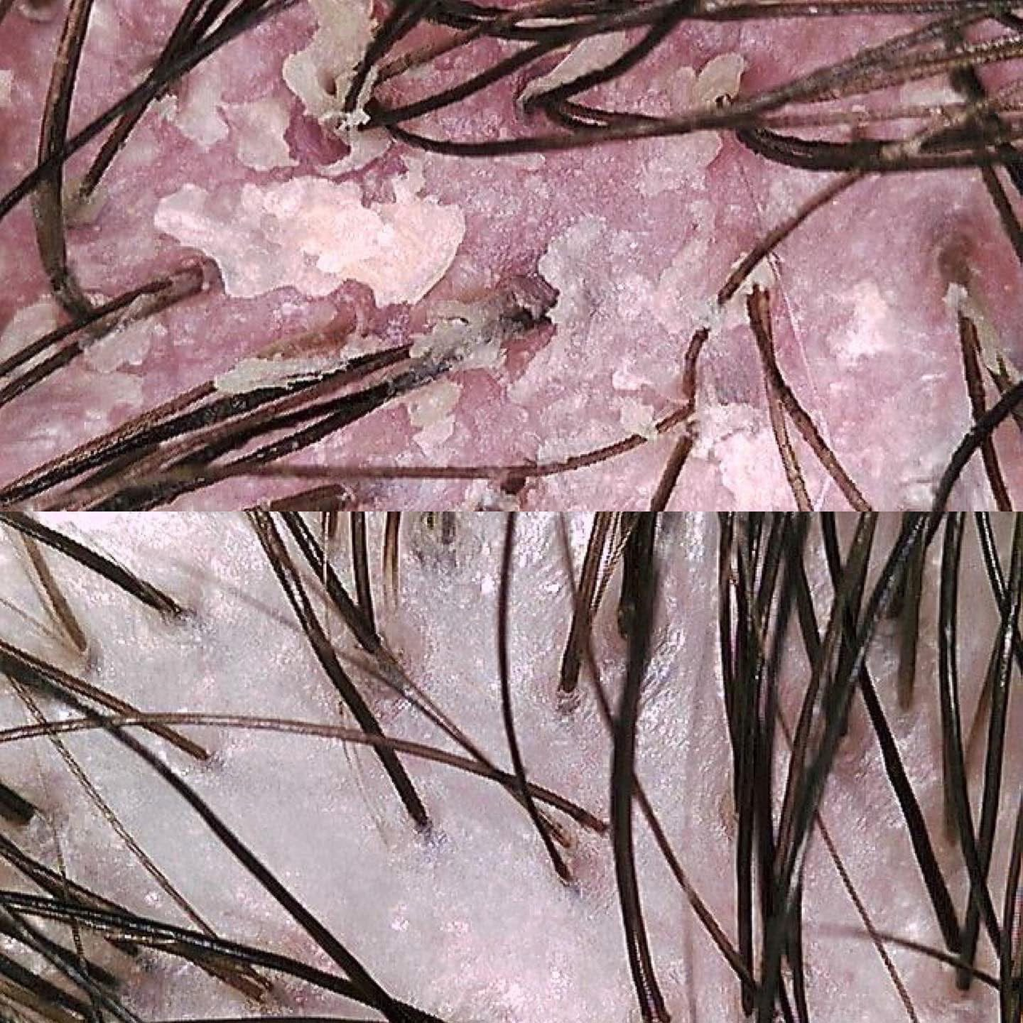 Scalp Detox Before & After